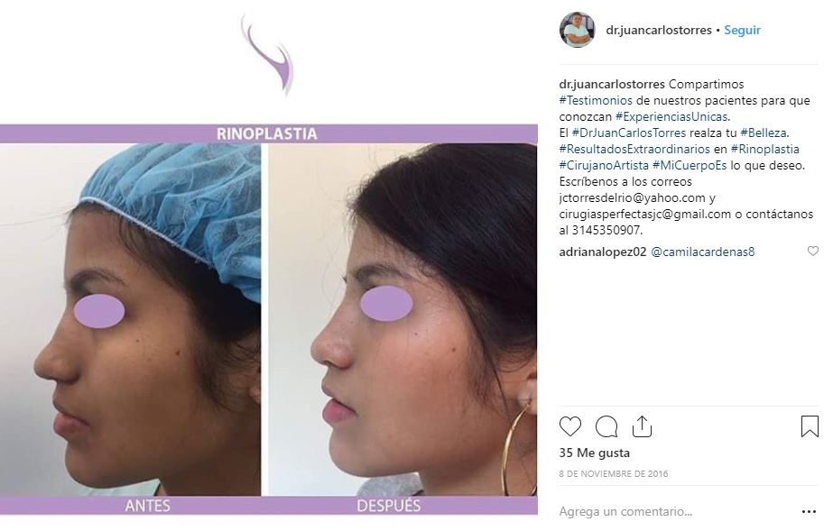 La joven de 22 años se realizó la rinoplastia en 2016, según fuentes cercanas.