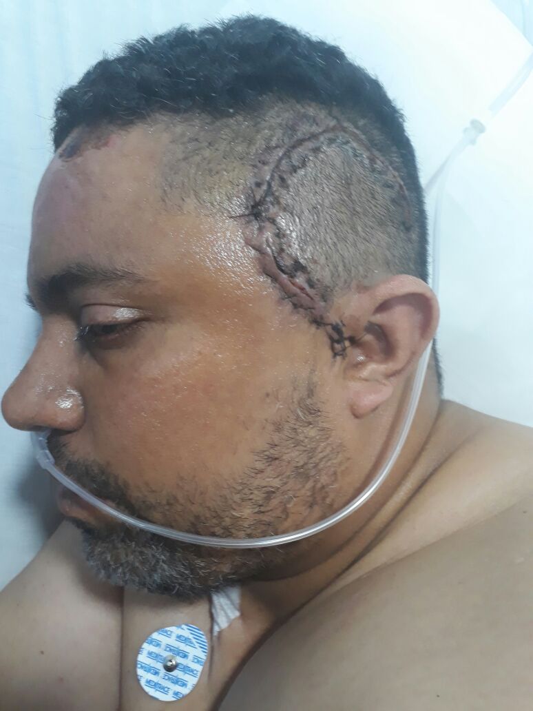 El último accidente de gravedad se registró hace 13, donde un motociclista identificado como Carlos Urieles por poco pierde la vida.