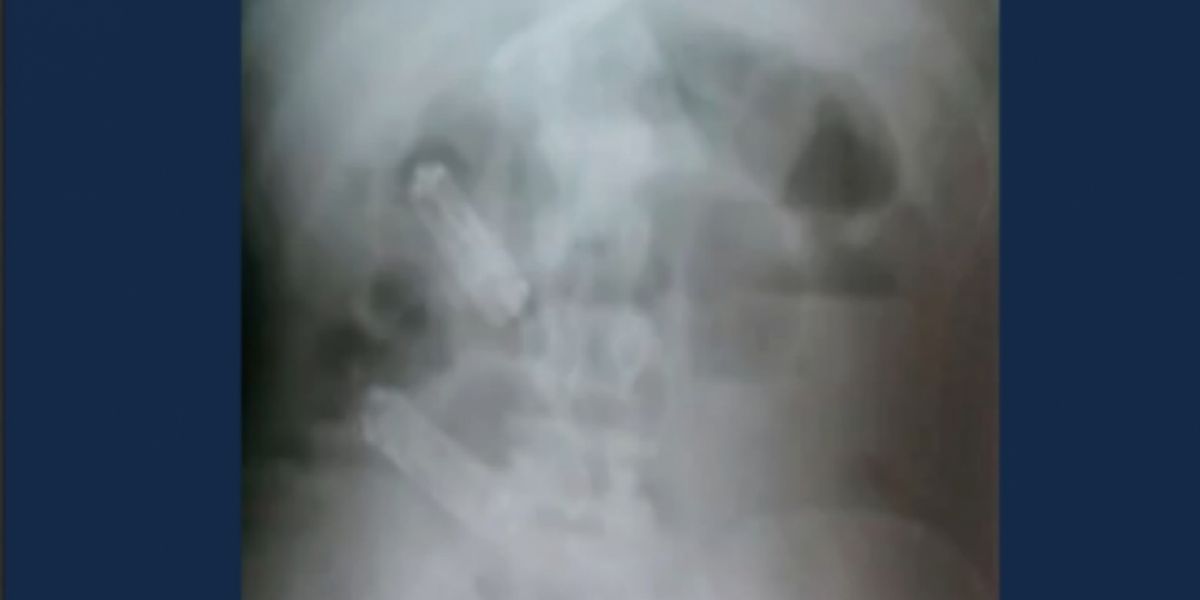 En la imagen de este rayos X se observan los celulares en el estómago del recluso.