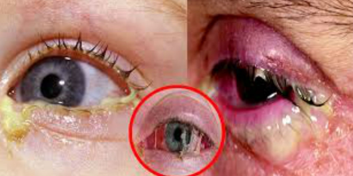 La conjuntivitis genera irritación de los ojos.