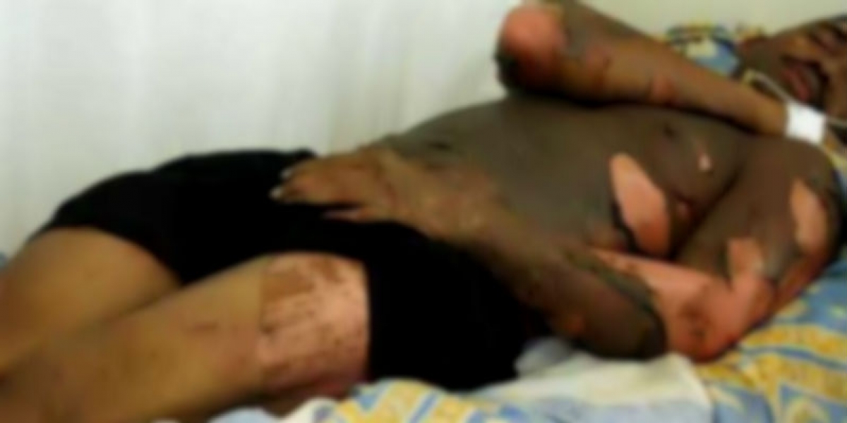 El paciente sufrió graves quemaduras en las piernas, por lo que necesitaba ser valorado por un especialista.