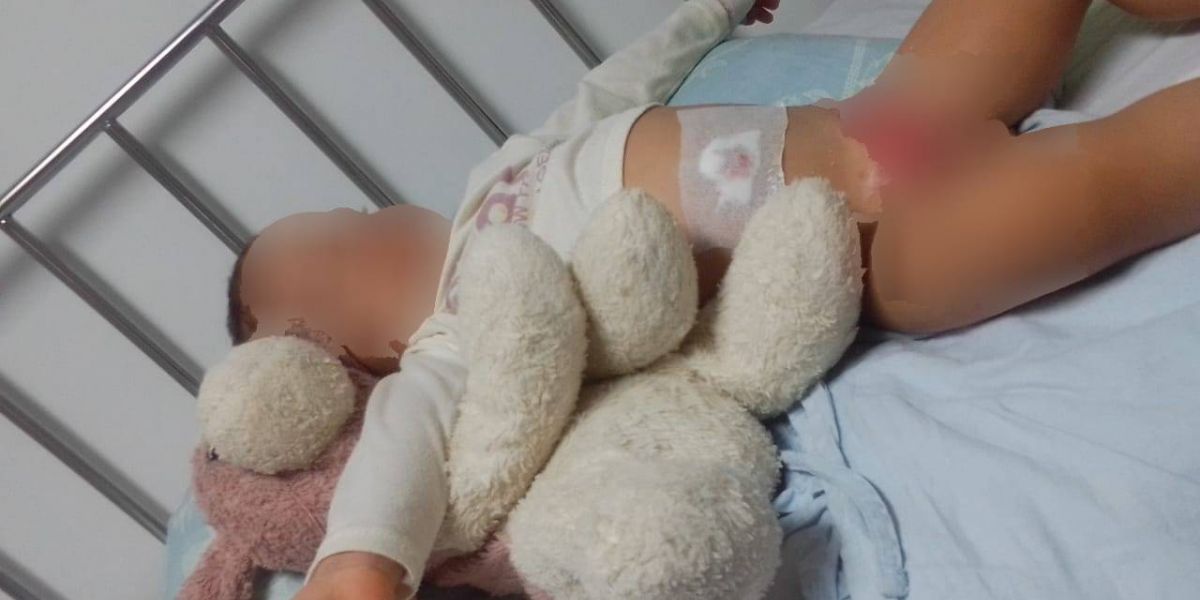 El bebé de 18 meses sigue en recuperación tras la quemadura sufrida.