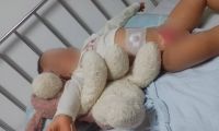 El bebé de 18 meses sigue en recuperación tras la quemadura sufrida.