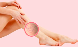 Ilustración várices